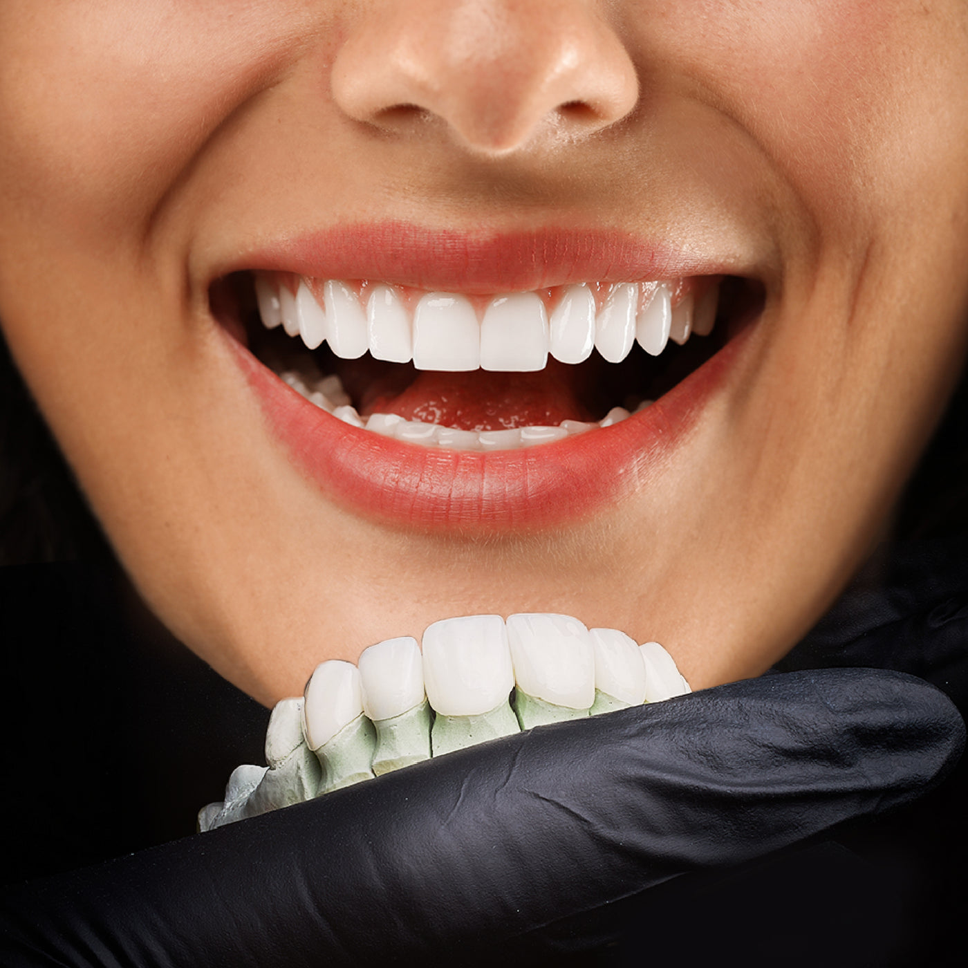 Custom-Fit Snap-On Teeth Veneers for Upper & Lower — Removable Cosmetic Veneers, Available in 4 Shades for a Natural-Looking Smile